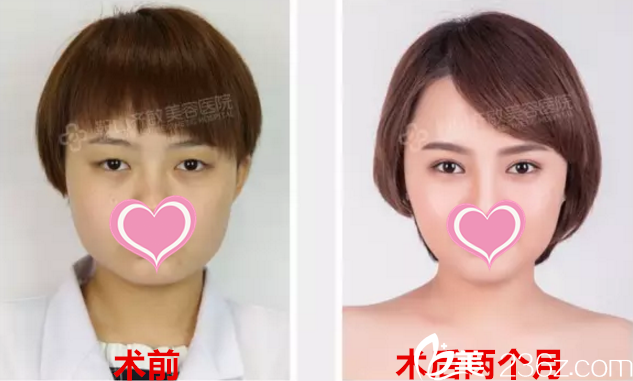 邱院長眼部整形真人案例前后對比 邱院長眼部整形真人案例前后對比