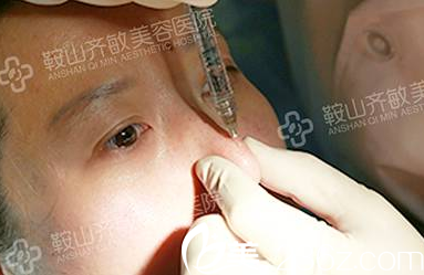 玻尿酸隆鼻 玻尿酸隆鼻