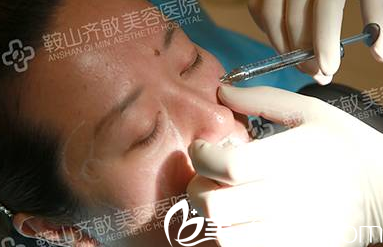 玻尿酸填充蘋果肌 玻尿酸填充蘋果肌