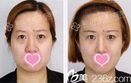 全面部玻尿酸填充前后對比 全面部玻尿酸填充前后對比