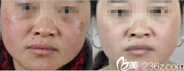 李玉梅激光祛斑前后對比案例 李玉梅激光祛斑前后對比案例