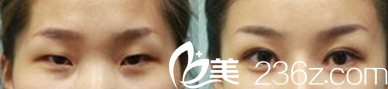 北京博美醫(yī)療美容診所袁玲風雙眼皮開眼角案例