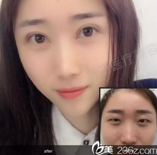 蔣新力打造的雙眼皮案例 蔣新力打造的雙眼皮案例