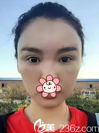 何山醫(yī)生給我做完后第四天的樣子 何山醫(yī)生給我做完后第四天的樣子