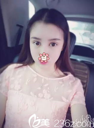 去支教也沒耽誤我找新疆華美瑪麗亞做雙眼皮+自體脂肪面部填充  