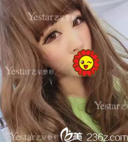 嘉興藝星做假體隆鼻手術(shù)前照片 嘉興藝星做假體隆鼻手術(shù)前照片