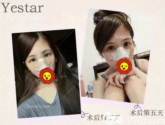 鼻綜合整形手術(shù)第5天恢復(fù)照 鼻綜合整形手術(shù)第5天恢復(fù)照