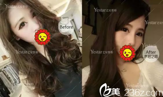 嘉興藝星隆鼻手術(shù)2周效果對比圖 嘉興藝星隆鼻手術(shù)2周效果對比圖