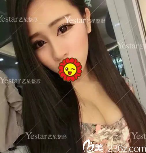 我就是嘉興藝星整形張占召做bsk宮廷鼻綜合隆鼻手術(shù)的一枚鮮活案例,現(xiàn)分享60天恢復(fù)日記