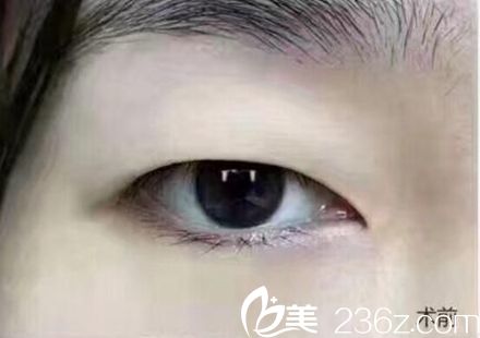 許昌博愛(ài)雙眼皮手術(shù)案例 許昌博愛(ài)雙眼皮手術(shù)案例