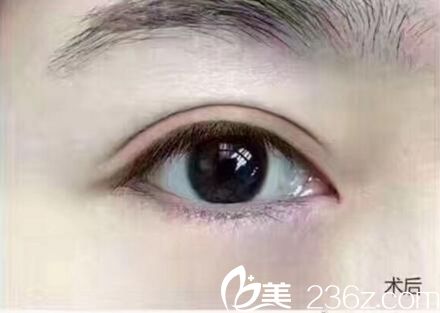 到許昌博愛打造大眼萌雙眼皮 讓我美的不止一點(diǎn)點(diǎn)