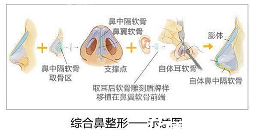 鼻綜合整形示意圖 鼻綜合整形示意圖