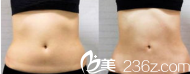 北京印正山醫(yī)療美容診所<!--<i data=20240703-sp></i>-->腹部吸脂案例 北京印正山醫(yī)療美容診所<!--<i data=20240703-sp></i>-->腹部吸脂案例