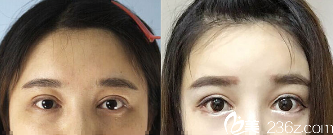 肇慶華美美容醫(yī)院黃萬宇下眼瞼下至術案例