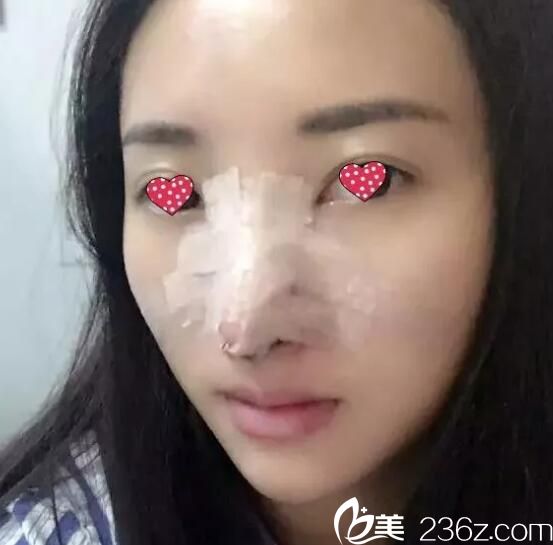 剛做完鼻綜合術(shù)后