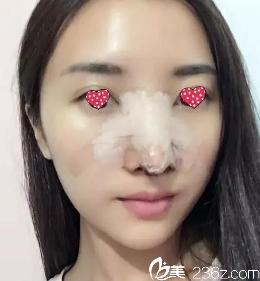 術(shù)后第三天隆鼻恢復(fù)