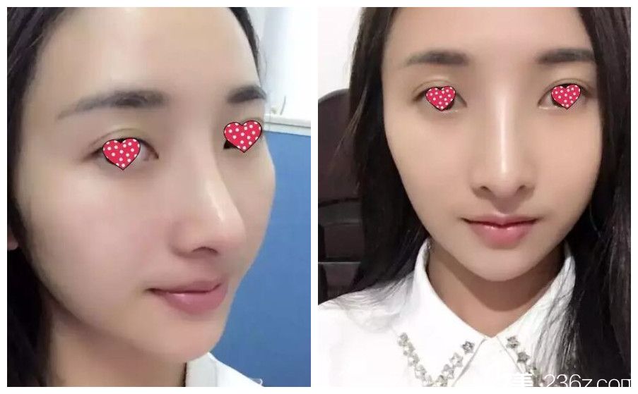 術(shù)后五天拆線鼻綜合恢復(fù)