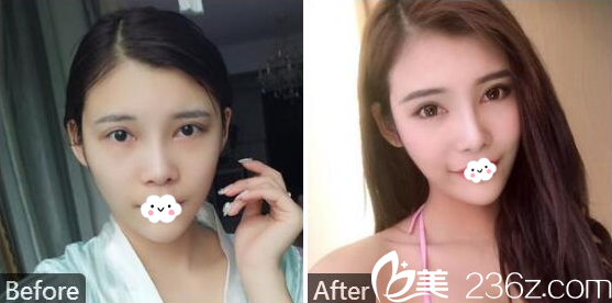 肇慶華美美容醫(yī)院黃萬宇雙眼皮隆鼻案例