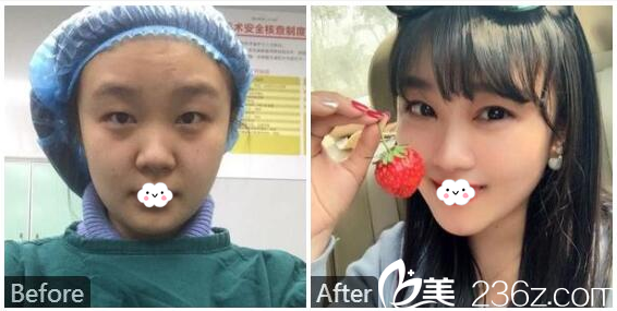 寶雞高一生整形醫(yī)院楊善主任做的雙眼皮案例