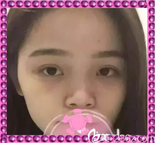 在<!--<i data=20240703-sp></i>-->整形醫(yī)院做隆鼻術(shù)前照 在<!--<i data=20240703-sp></i>-->整形醫(yī)院做隆鼻術(shù)前照