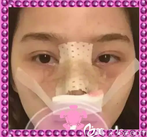 綜合隆鼻術(shù)后第三天包著紗布的樣子 綜合隆鼻術(shù)后第三天包著紗布的樣子