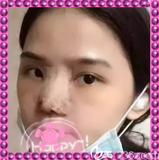 做完鼻綜合整形術(shù)后第7天去醫(yī)院取了鼻夾 做完鼻綜合整形術(shù)后第7天去醫(yī)院取了鼻夾