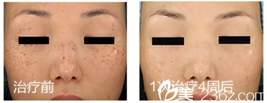 揭陽(yáng)華美整形醫(yī)院超皮秒祛色斑案例