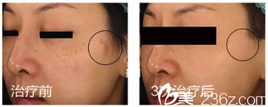 揭陽(yáng)華美整形醫(yī)院超皮秒咖啡牛奶斑祛除案例