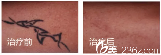 揭陽(yáng)華美整形醫(yī)院超皮秒紋身祛除案例