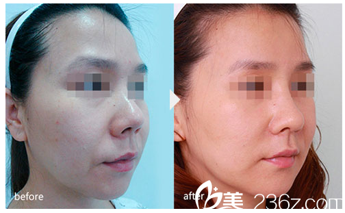 揭陽(yáng)華美整形醫(yī)院假體隆鼻案例