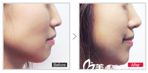 揭陽(yáng)華美整形醫(yī)院玻尿酸隆鼻案例