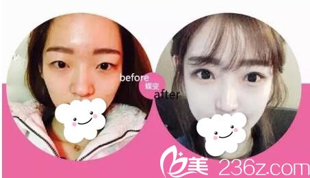 眼鼻綜合術(shù)前術(shù)后對(duì)比案例