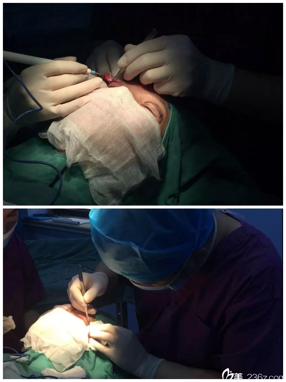 雙眼皮+開(kāi)眼角手術(shù)過(guò)程中
