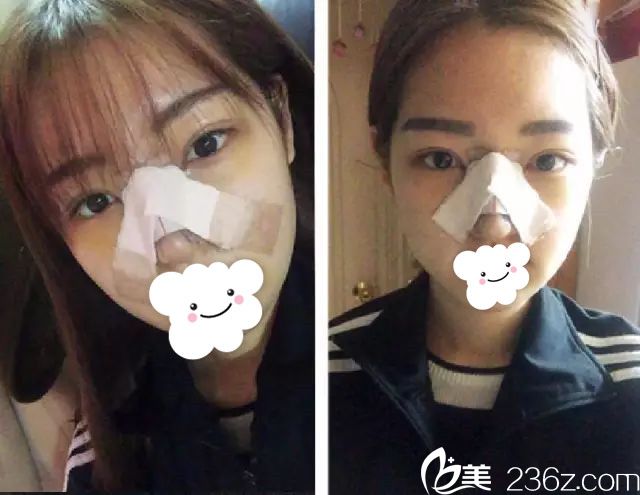 鼻綜合加眼綜合術(shù)后恢復(fù)中