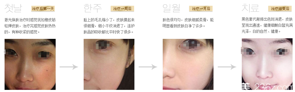 連云港美締激光煥膚案例 連云港美締激光煥膚案例