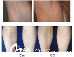 孟雪梅主任脫毛案例 孟雪梅主任脫毛案例