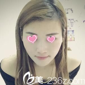 在廊坊艾美整形醫(yī)院打瘦臉20天后 別人都以為我瘦了20斤