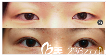 河源華美整形醫(yī)院何為院長雙眼皮案例 河源華美整形醫(yī)院何為院長雙眼皮案例