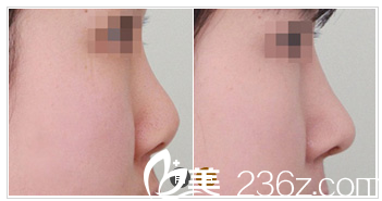 河源華美整形醫(yī)院何為院長隆鼻案例 河源華美整形醫(yī)院何為院長隆鼻案例