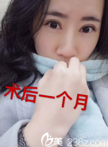 找河源華美整形醫(yī)院何為院長做完全切雙眼皮后整個人都變得自信了