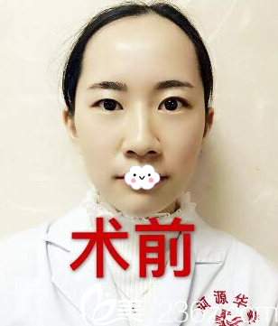 雙眼皮術(shù)前照 雙眼皮術(shù)前照