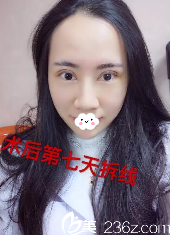 河源華美整形醫(yī)院雙眼皮7天拆線效果 河源華美整形醫(yī)院雙眼皮7天拆線效果