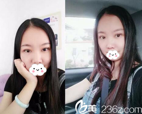 廣東揭陽(yáng)割雙眼皮哪家醫(yī)院好？揭陽(yáng)華美雙眼皮的價(jià)格不貴技術(shù)還好哦