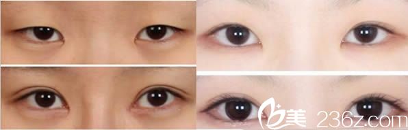 寧德華美王貴賢雙眼皮案例 寧德華美王貴賢雙眼皮案例