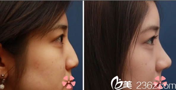 <!--<i data=20240703-sp></i>-->生鼻綜合隆鼻前后對(duì)比效果 <!--<i data=20240703-sp></i>-->生鼻綜合隆鼻前后對(duì)比效果