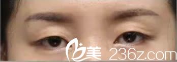 在寧德華美整形醫(yī)院做雙眼皮術(shù)前照 在寧德華美整形醫(yī)院做雙眼皮術(shù)前照