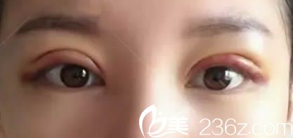 全切雙眼皮術(shù)后第4天就基本消腫了 全切雙眼皮術(shù)后第4天就基本消腫了