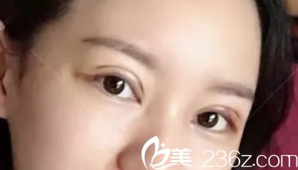 讓<!--<i data=20240703-sp></i>-->生做全切雙眼皮術(shù)后第6天的照片 讓<!--<i data=20240703-sp></i>-->生做全切雙眼皮術(shù)后第6天的照片