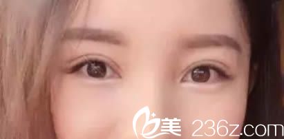 寧德華美生給我割的雙眼皮都一個(gè)月啦，今天跟大家分享我的親身經(jīng)歷