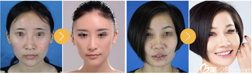 徐瑞迎醫(yī)生祛痘案例 徐瑞迎醫(yī)生祛痘案例